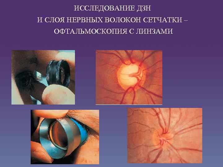 ИССЛЕДОВАНИЕ ДЗН И СЛОЯ НЕРВНЫХ ВОЛОКОН СЕТЧАТКИ – ОФТАЛЬМОСКОПИЯ С ЛИНЗАМИ 