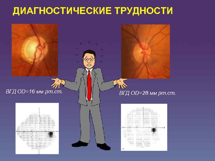 ДИАГНОСТИЧЕСКИЕ ТРУДНОСТИ ВГД OD=16 мм рт. ст. ВГД OD=28 мм рт. ст. 