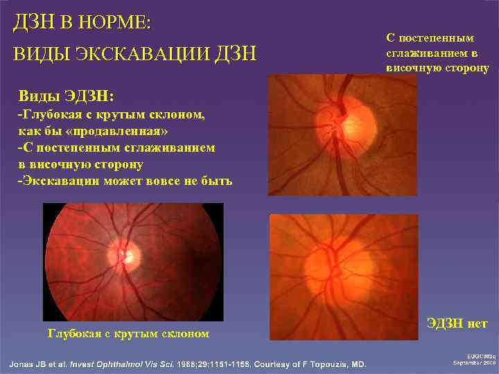 Норма зрительного нерва. Глаукомная экскавация зрительного нерва. Диск зрительного нерва при гиперметропии. Экскавация диска зрительного нерва окт. Э/Д зрительного нерва нормы.
