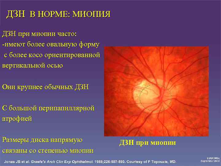 Норма зрительного нерва. Экскавации диска зрительного нерва клиника. Деколорирован диск зрительного нерва.