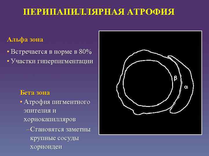 ПЕРИПАПИЛЛЯРНАЯ АТРОФИЯ Альфа зона • Встречается в норме в 80% • Участки гиперпигментации Бета