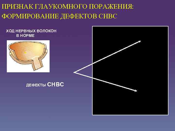 ПРИЗНАК ГЛАУКОМНОГО ПОРАЖЕНИЯ: ФОРМИРОВАНИЕ ДЕФЕКТОВ СНВC ХОД НЕРВНЫХ ВОЛОКОН В НОРМЕ ДЕФЕКТЫ СНВС 