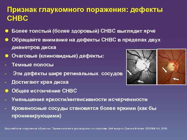 Признак глаукомного поражения: дефекты СНВC l Более толстый (более здоровый) СНВC выглядит ярче l