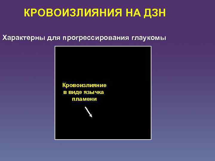 КРОВОИЗЛИЯНИЯ НА ДЗН Характерны для прогрессирования глаукомы Кровоизлияние в виде язычка пламени 
