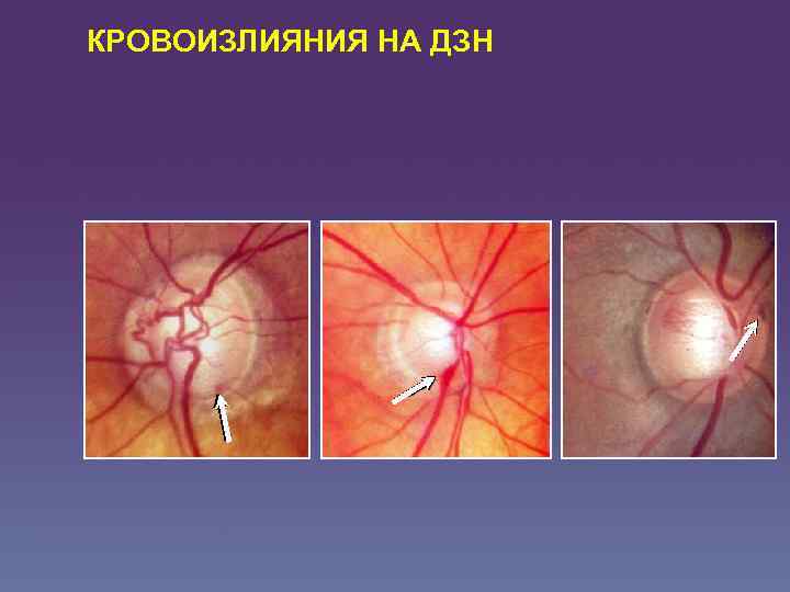 КРОВОИЗЛИЯНИЯ НА ДЗН 