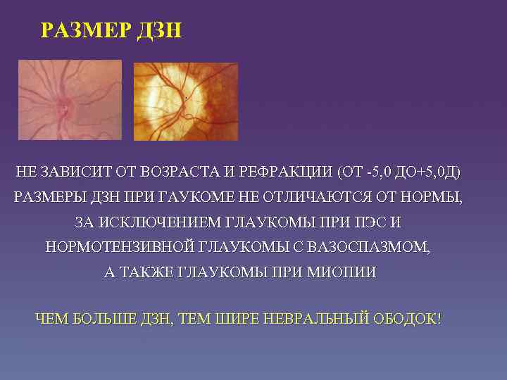 РАЗМЕР ДЗН НЕ ЗАВИСИТ ОТ ВОЗРАСТА И РЕФРАКЦИИ (ОТ -5, 0 ДО+5, 0 Д)