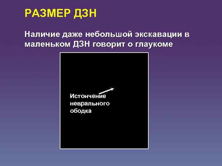 РАЗМЕР ДЗН Наличие даже небольшой экскавации в маленьком ДЗН говорит о глаукоме Истончение неврального