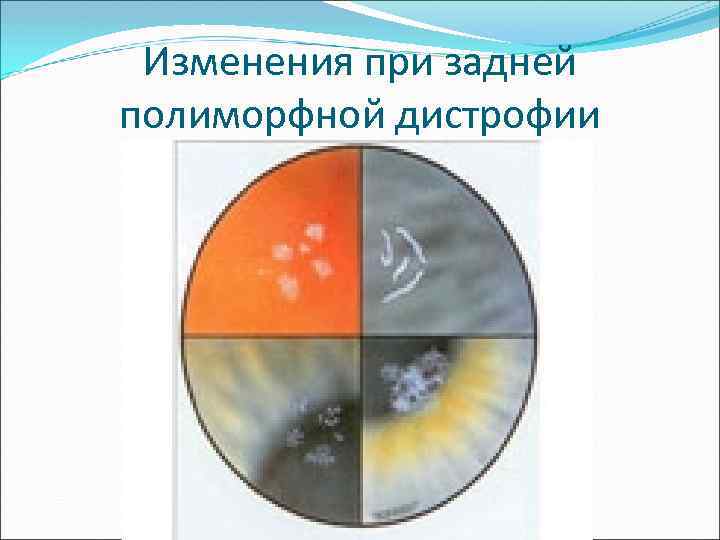 Изменения при задней полиморфной дистрофии 