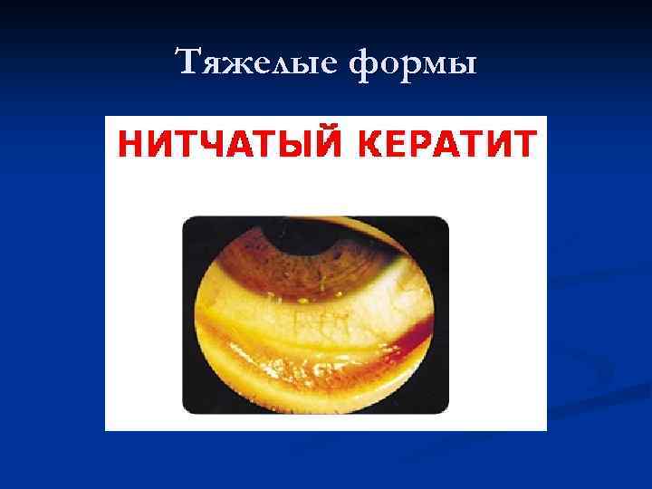 Тяжелые формы 