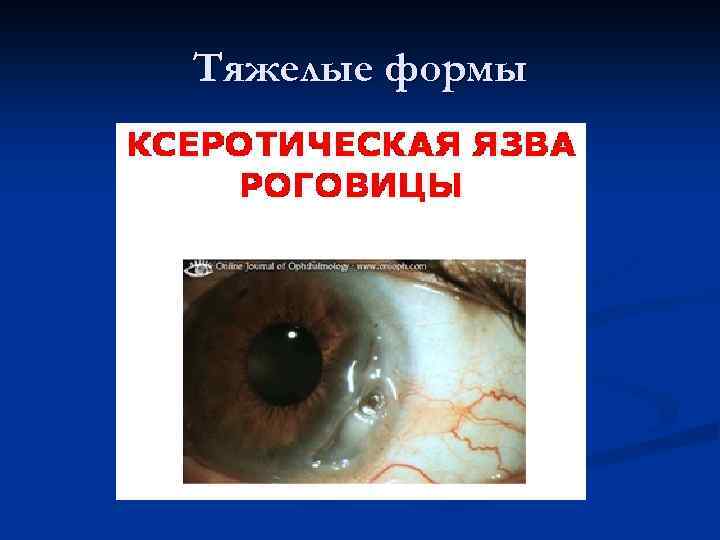 Тяжелые формы 