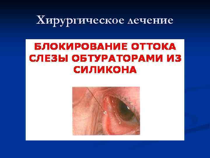 Хирургическое лечение 