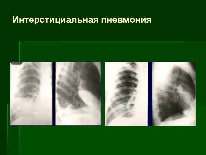 Интерстициальная пневмония 