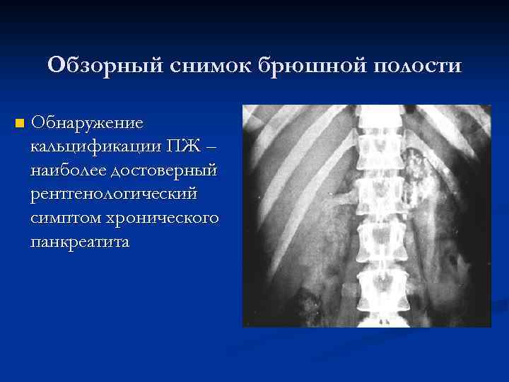 Обзорный снимок брюшной полости n Обнаружение кальцификации ПЖ – наиболее достоверный рентгенологический симптом хронического