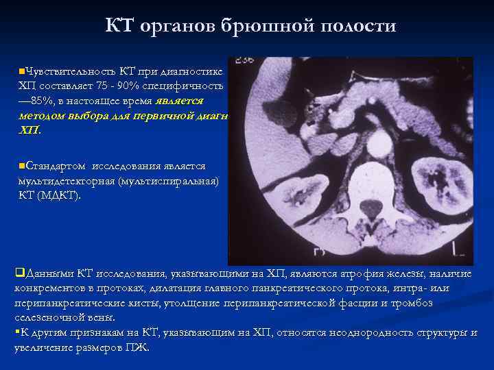 КТ органов брюшной полости n. Чувствительность КТ при диагностике ХП составляет 75 - 90%