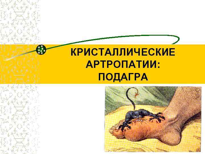 КРИСТАЛЛИЧЕСКИЕ АРТРОПАТИИ: ПОДАГРА 