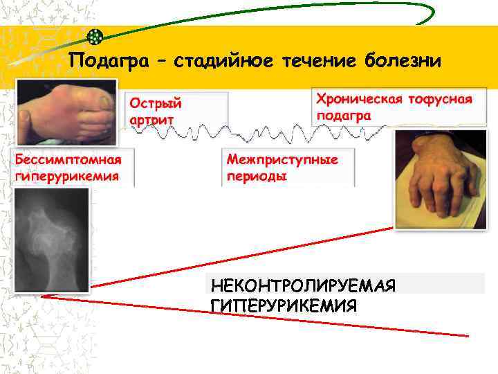 Подагра – стадийное течение болезни НЕКОНТРОЛИРУЕМАЯ ГИПЕРУРИКЕМИЯ 