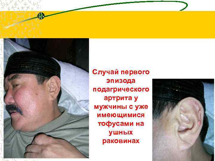 Случай первого эпизода подагрического артрита у мужчины с уже имеющимися тофусами на ушных раковинах
