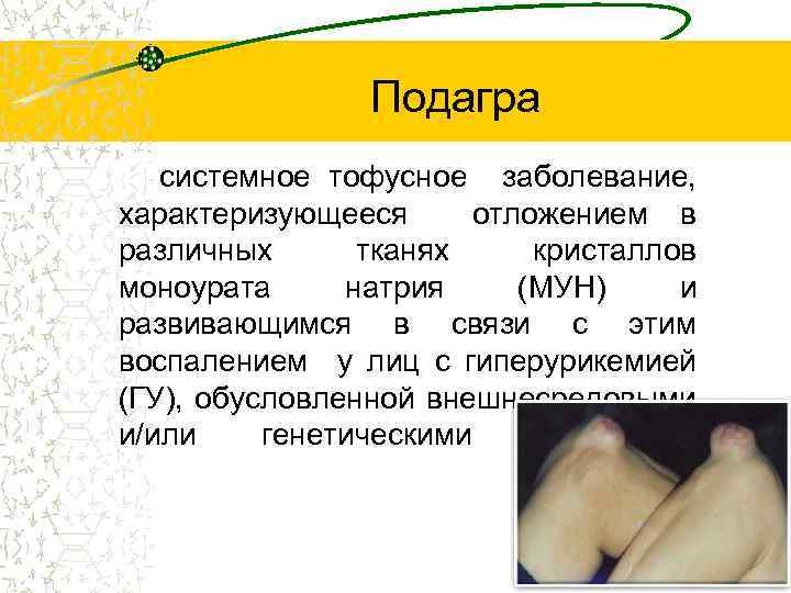  Подагра системное тофусное заболевание, характеризующееся отложением в различных тканях кристаллов моноурата натрия (МУН)