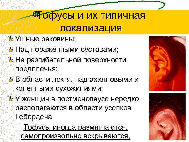 Тофусы и их типичная локализация Ушные раковины; Над пораженными суставами; На разгибательной поверхности предплечья;