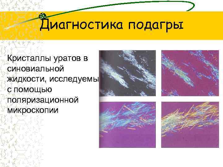 Диагностика подагры Кристаллы уратов в синовиальной жидкости, исследуемые с помощью поляризационной микроскопии 