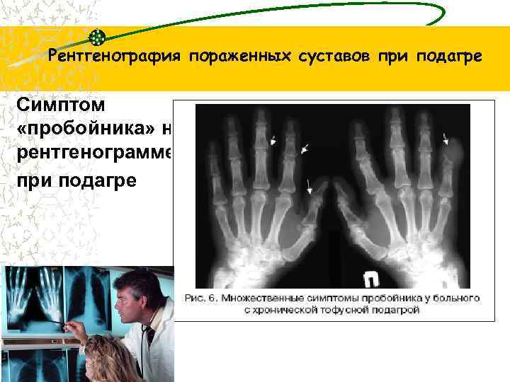 Рентген картина при подагре