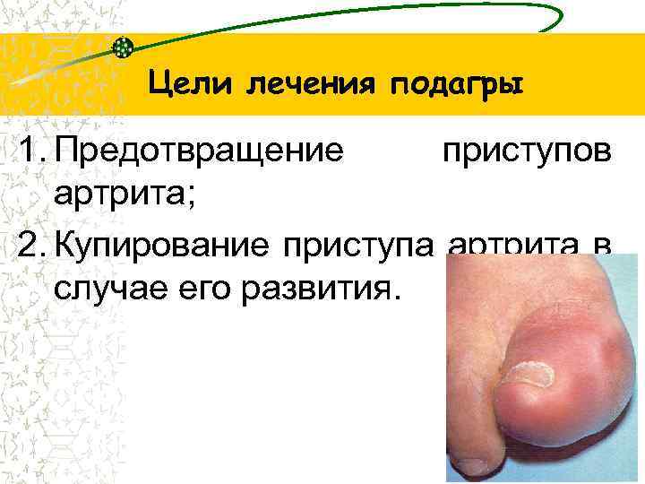 Цели лечения подагры 1. Предотвращение приступов артрита; 2. Купирование приступа артрита в случае его