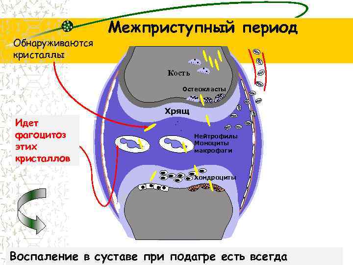 Обнаруживаются кристаллы Межприступный период Кость Остеокласты Идет фагоцитоз этих кристаллов Хрящ Нейтрофилы Моноциты макрофаги
