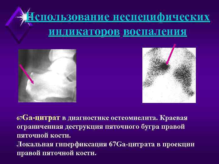 Использование неспецифических индикаторов воспаления 67 Ga-цитрат в диагностике остеомиелита. Краевая ограниченная деструкция пяточного бугра