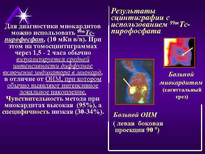Для диагностики миокардитов можно использовать 99 m. Тспирофосфат, (10 м. Ки в/в). При этом