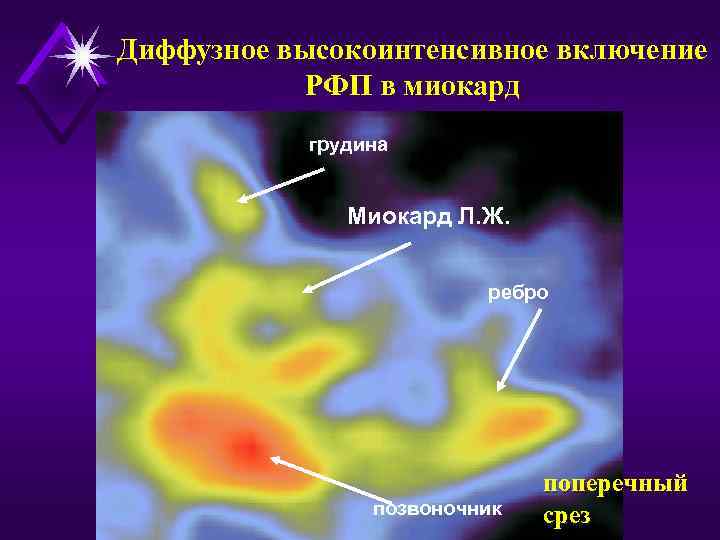Диффузное высокоинтенсивное включение РФП в миокард грудина Миокард Л. Ж. ребро позвоночник поперечный срез