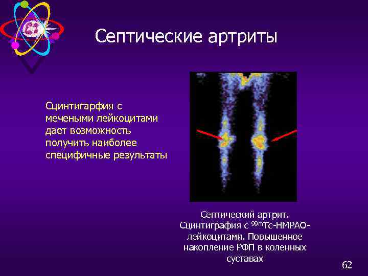Септические артриты Сцинтигарфия с мечеными лейкоцитами дает возможность получить наиболее специфичные результаты Септический артрит.