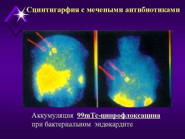 Сцинтигарфия с мечеными антибиотиками Аккумуляция 99 m. Tc-ципрофлоксацина при бактериальном эндокардите 