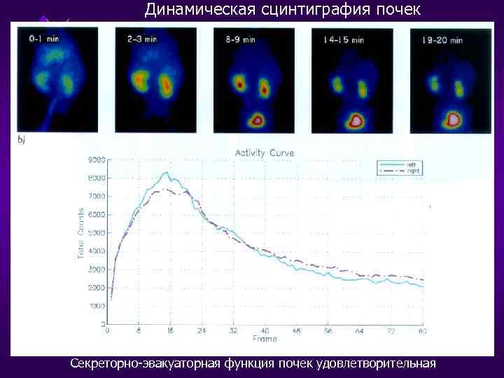Динамическая сцинтиграфия почек Секреторно-эвакуаторная функция почек удовлетворительная 