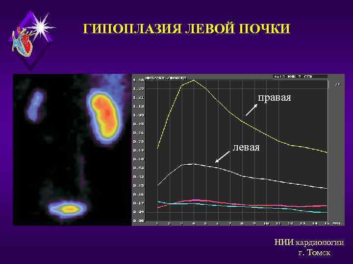 ГИПОПЛАЗИЯ ЛЕВОЙ ПОЧКИ правая левая НИИ кардиологии г. Томск 