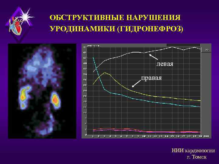 ОБСТРУКТИВНЫЕ НАРУШЕНИЯ УРОДИНАМИКИ (ГИДРОНЕФРОЗ) левая правая НИИ кардиологии г. Томск 