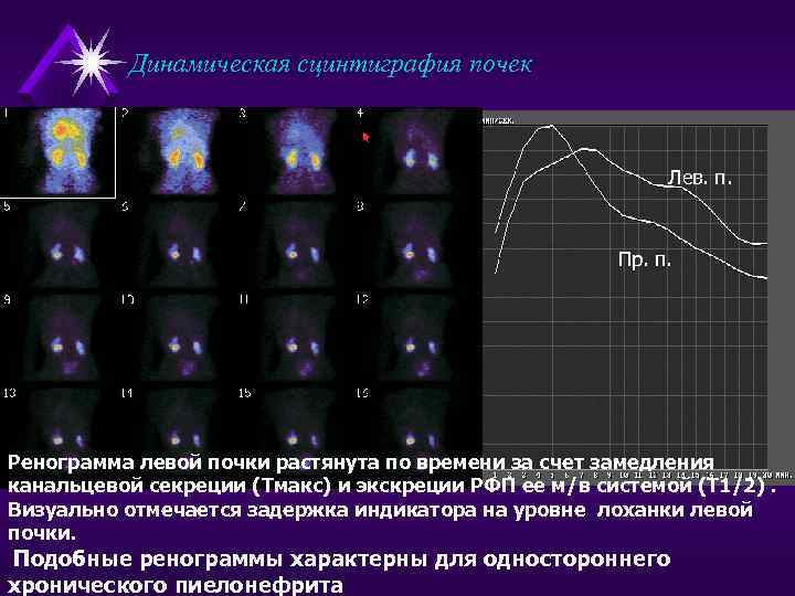 Динамическая сцинтиграфия почек Лев. п. Пр. п. Ренограмма левой почки растянута по времени за