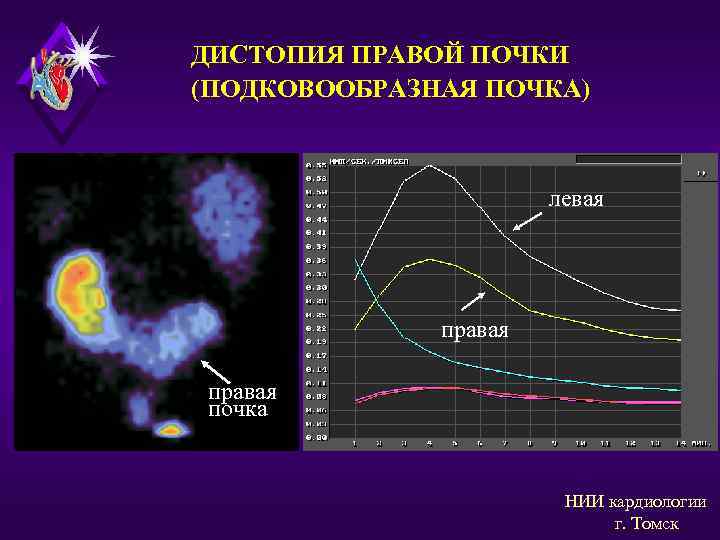 ДИСТОПИЯ ПРАВОЙ ПОЧКИ (ПОДКОВООБРАЗНАЯ ПОЧКА) левая правая почка НИИ кардиологии г. Томск 