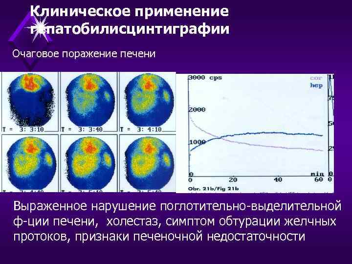 Клиническое применение гепатобилисцинтиграфии Очаговое поражение печени Выраженное нарушение поглотительно-выделительной ф-ции печени, холестаз, симптом обтурации