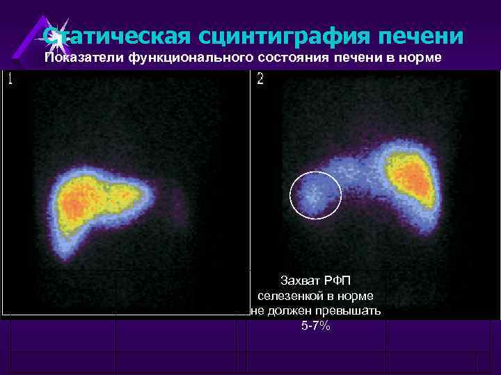 Статическая сцинтиграфия печени Показатели функционального состояния печени в норме Захват РФП селезенкой в норме