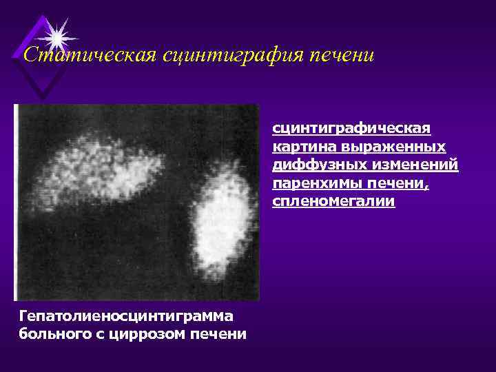 Статическая сцинтиграфия печени сцинтиграфическая картина выраженных диффузных изменений паренхимы печени, спленомегалии Гепатолиеносцинтиграмма больного с