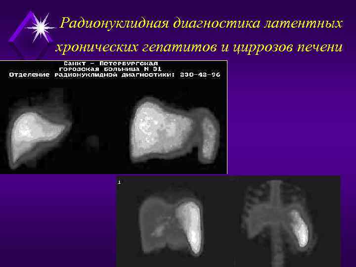Радионуклидная диагностика латентных хронических гепатитов и циррозов печени 