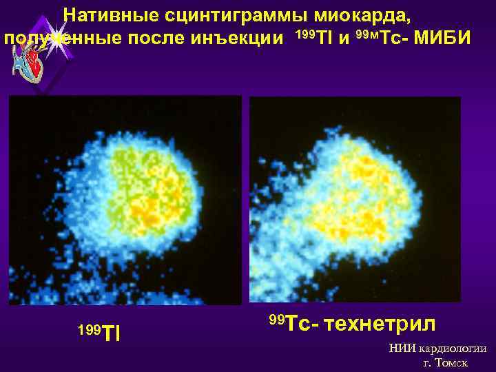 Нативные сцинтиграммы миокарда, полученные после инъекции 199 Тl и 99 м. Tс- МИБИ 199