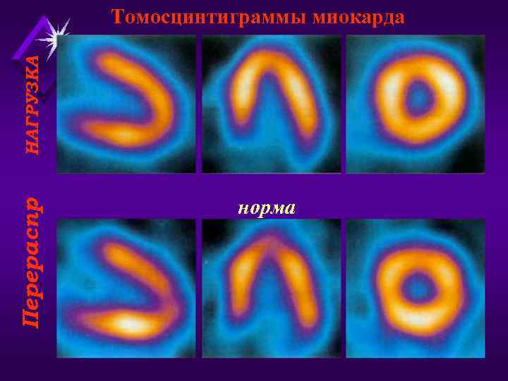 Перераспр. НАГРУЗКА Томосцинтиграммы миокарда норма 