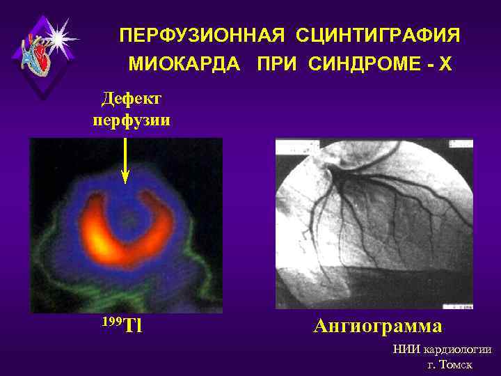 ПЕРФУЗИОННАЯ СЦИНТИГРАФИЯ МИОКАРДА ПРИ СИНДРОМЕ - Х Дефект перфузии 199 Tl Ангиограмма НИИ кардиологии
