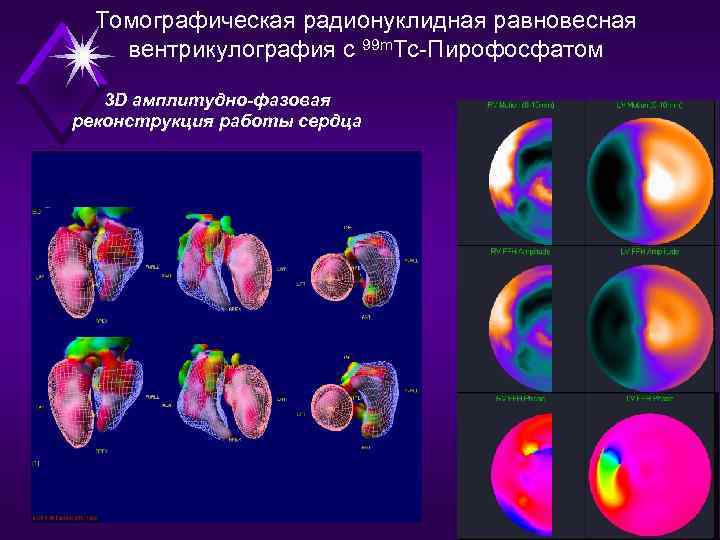 Томографическая радионуклидная равновесная вентрикулография c 99 m. Tc-Пирофосфатом 3 D амплитудно-фазовая реконструкция работы сердца