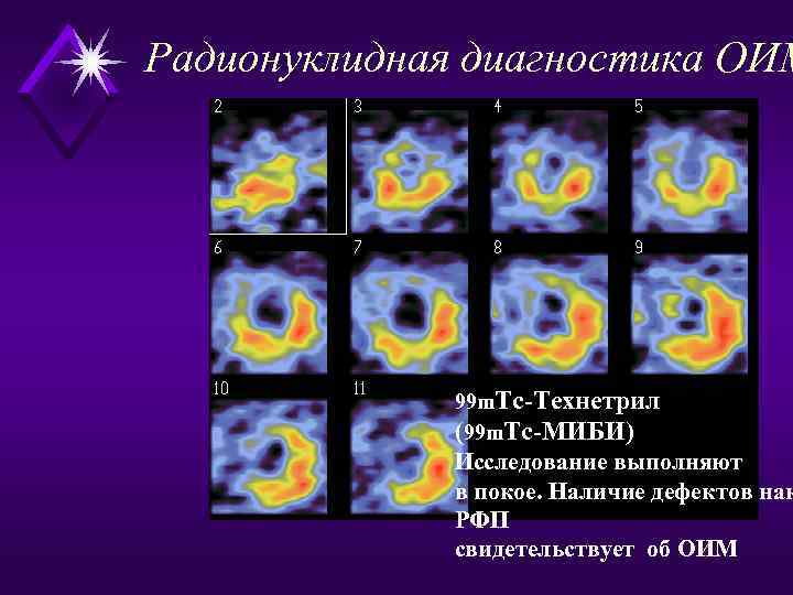 Радионуклидная диагностика ОИМ 99 m. Тс-Технетрил (99 m. Тс-МИБИ) Исследование выполняют в покое. Наличие