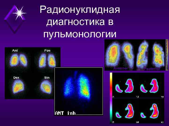 Радионуклидная диагностика. Методы радионуклидной диагностики. Радиоизотопные (радионуклидные) исследования. Радионуклидное исследование легких.