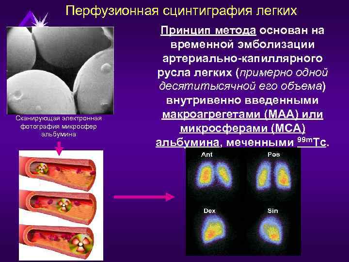Перфузионная сцинтиграфия легких Сканирующая электронная фотография микросфер альбумина Принцип метода основан на временной эмболизации