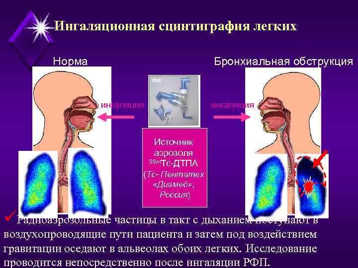 Ингаляционная сцинтиграфия легких Норма Бронхиальная обструкция ингаляция Источник аэрозоля 99 m. Tc-ДТПА (Тс- Пентатех