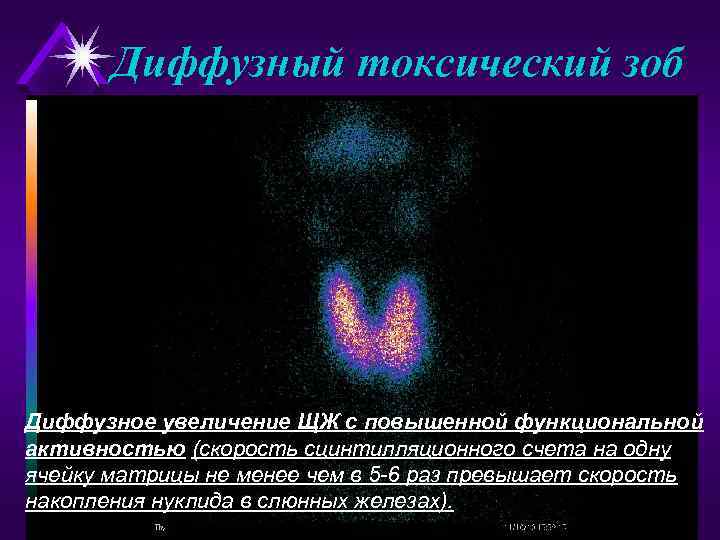 Диффузный токсический зоб Диффузное увеличение ЩЖ с повышенной функциональной активностью (скорость сцинтилляционного счета на